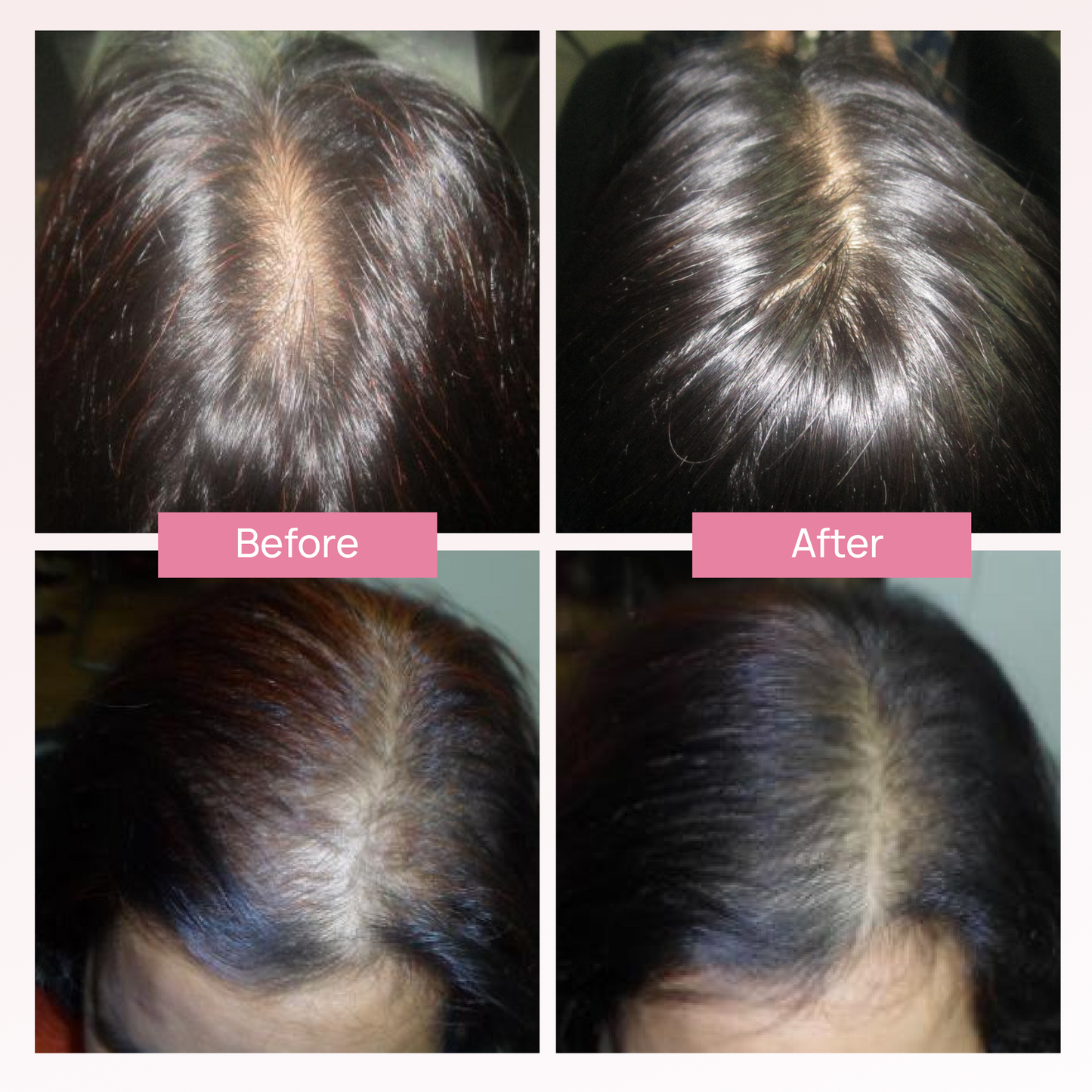 ANAGROW® – Advanced Hair Regrowth Serum with Apple Stem Cells