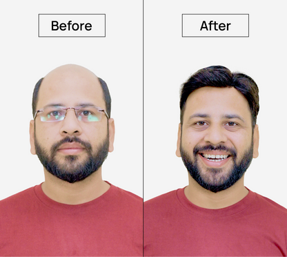 Polyfuse Hair System: An Ultra-Thin, Lightweight, & Transparent Hair Base